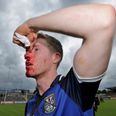 Picture: A bloodied Rory Dunne after the match against Fermanagh