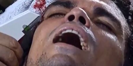 Video: Pepe had a nasty face wound stapled shut on the pitch last night (Warning: Graphic Content)