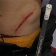 Video: That’s hockey, folks! Player gets torso slashed by skate, plays on, scores winner