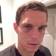 Daniel Agger shows off war wounds and brands Mignolet ‘hardcore’ after Liverpool win