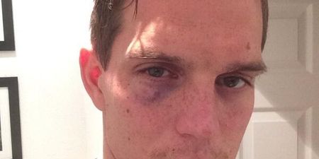 Daniel Agger shows off war wounds and brands Mignolet ‘hardcore’ after Liverpool win