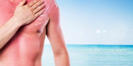Pic: Apply sun screen to avoid looking like this lad from Donegal