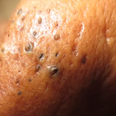 Video:  This disgusting video of zit-popping is so bad we can’t even look away