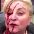 Video: Water charges protestor sustains nasty-looking facial injuries in Dublin (NSFW)