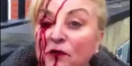 Video: Water charges protestor sustains nasty-looking facial injuries in Dublin (NSFW)