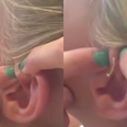 VIDEO: Girl pops a 6-year-old spot and what comes out of it is alarming