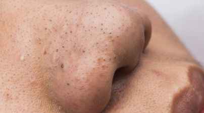 This handy hack can make getting rid of blackheads much easier