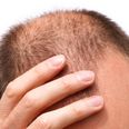 PIC: Men should avoid this one particular hairstyle because it makes you go bald