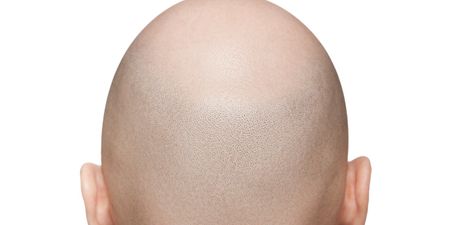 JOE BLOGS: 5 things I’ve learned from my year with alopecia