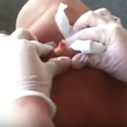 VIDEO: This guy’s 30-year-old cyst being popped is even more disgusting than you’d imagine