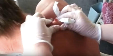 VIDEO: This guy’s 30-year-old cyst being popped is even more disgusting than you’d imagine