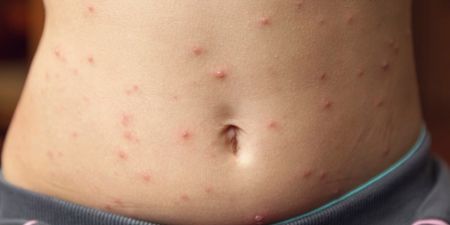 The HSE is dealing with an outbreak of measles in Dublin north inner city