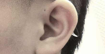 Here is why only some people have tiny holes above their ears