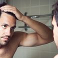 5 things to think about before getting a hair transplant