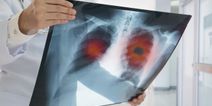 Irish Cancer Society calls for lung cancer screening programme to be introduced
