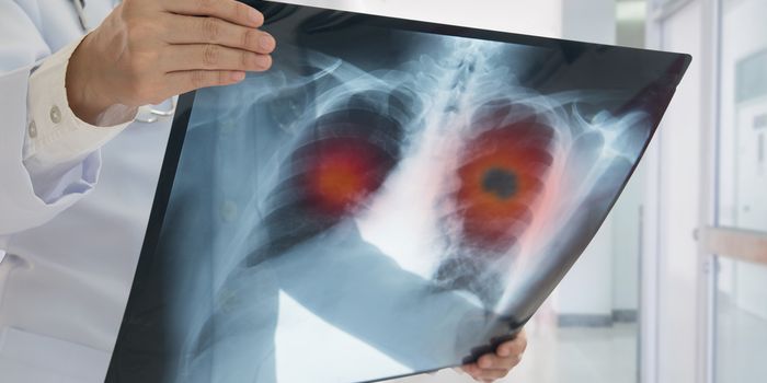 lung cancer screening ireland