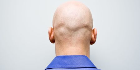 Calling men bald is now sex harassment, judge rules