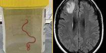 Live worm found in woman’s brain in world first discovery